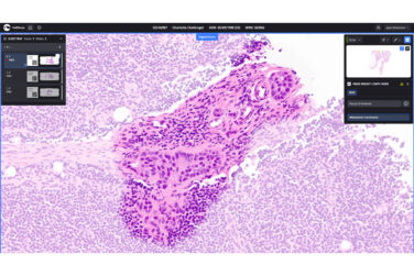 Screenshot showing Paige Lymph Node's ability to detect the presence of breast cancer metastases
