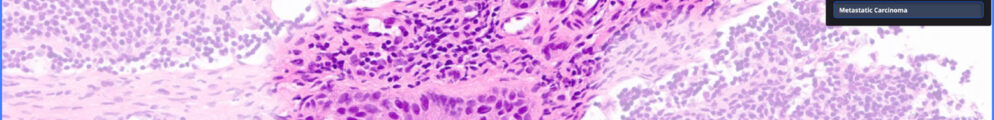 Screenshot showing Paige Lymph Node's ability to detect the presence of breast cancer metastases